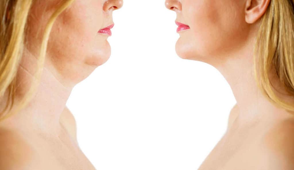 Double Chin treatment Rutland before and after results