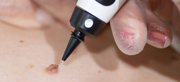 After Skin Tag Removal Rutland