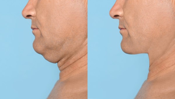 Which Non-Surgical Treatments Work Best for Jowls and Loose Skin Rutland?