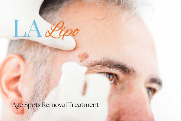 What Are the Most Effective Treatments for Age Spots Rutland?