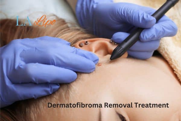 Dermatofibroma Removal Treatment Rutland