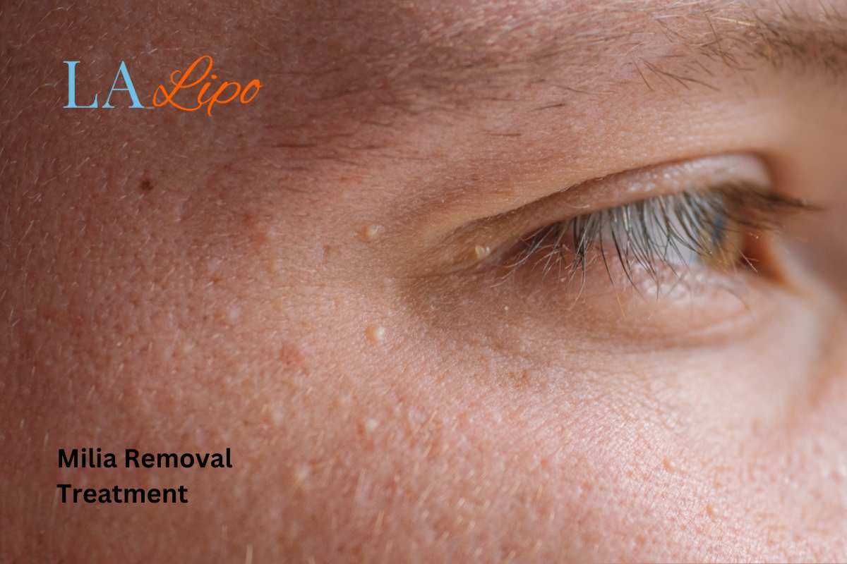 Cryopen Milia Removal: Is It the Easiest and Safest Option Rutland?