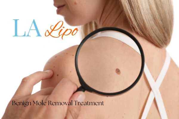Woman having her inspection of blemish before mole removal Rutland