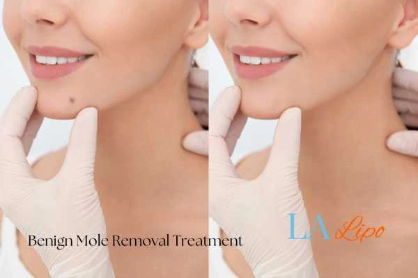 woman's before and after mole removal Rutland results