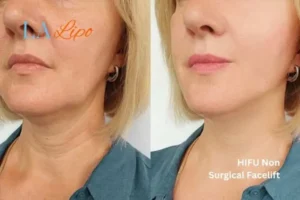 hi-fu for wrinkles Rutland before and after results