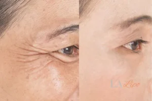 Before and after results of woman - HI-fu wrinkles reduction treatment Rutland