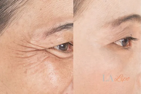 Before and after results of woman - HI-fu wrinkles reduction treatment Rutland