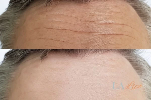 results of HIFU Rutland on mans forehead to help reduce lines and wrinkles