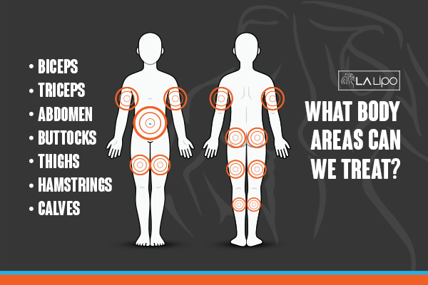 Graphic to show areas you can have LA-EMS Body Sculpting Rutland treatment.