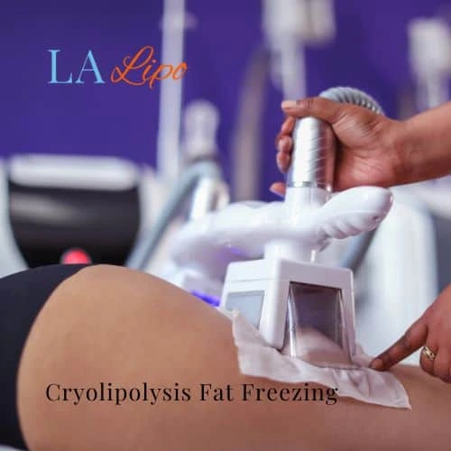 fat freezing - Cryolipolysis Rutland