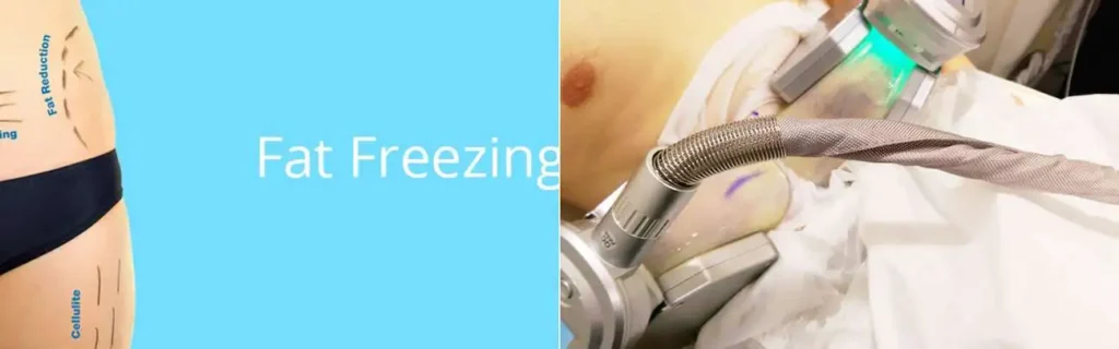 Fat freezing Rutland on multiple areas of the body