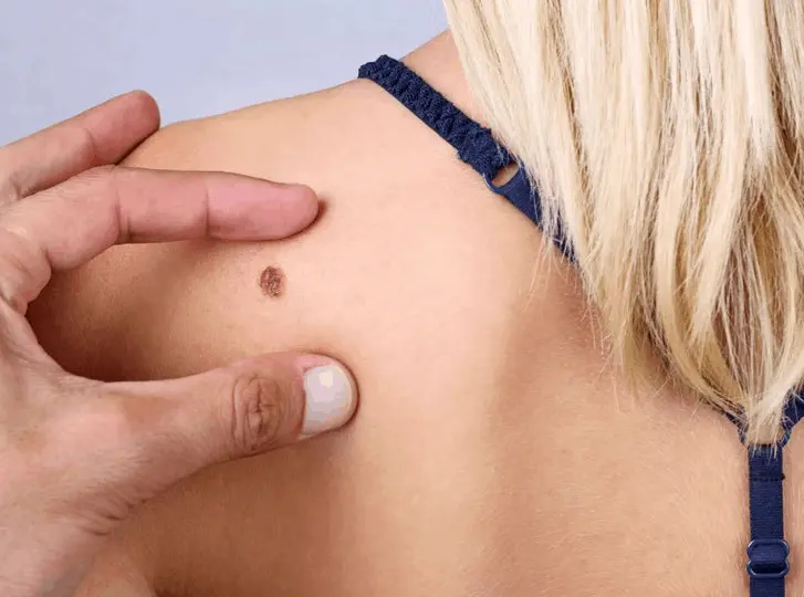 woman having mole removal Rutland consultation before treatment.