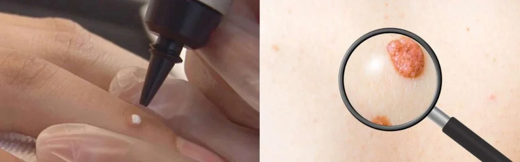 Person getting moles removed with cryopen Rutland