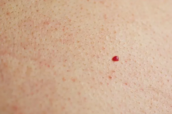close up of a cherry angioma Rutland