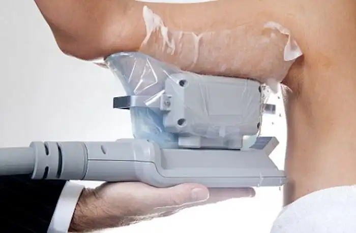 Picture of fat freezing Rutland on the upper arms.