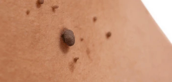 image of a skin tag Rutland