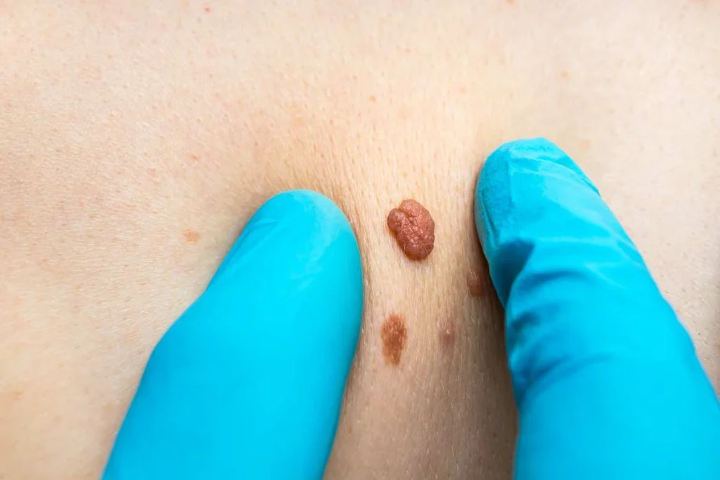 Consultant examining a skin tag Rutland