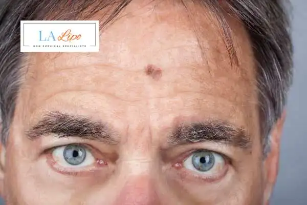 Solar Lentigo Removal Rutland image of man with mark on his forehead