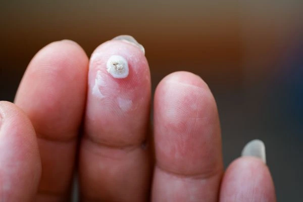 wart on person finger - cryotherapy to treat from LA LIPO Rutland