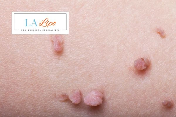 Does cryopen skin tag removal Rutland hurt? Find out now call our team today!