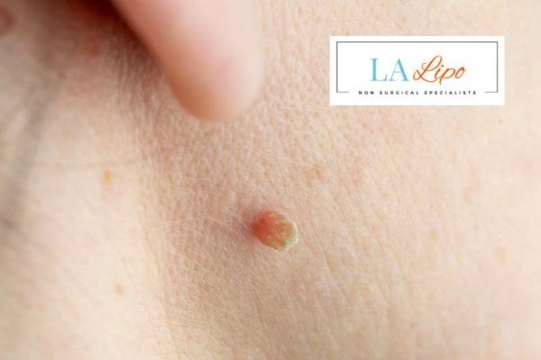Book skin tag removal Rutland today speak to our team now!