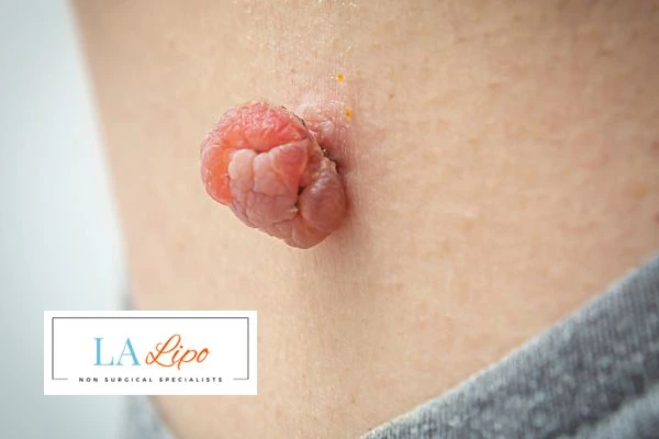 Interested in skin tag removal Rutland? Concerned about the pain? Find out more today!