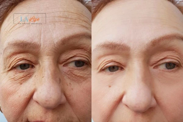 The powerful benefits of Morpheus8 Treatment Rutland - Call Our team today!