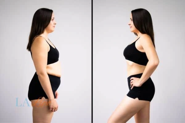 Picture of womans before and after using LA-EMS body sculpting to improve her core strength Rutland