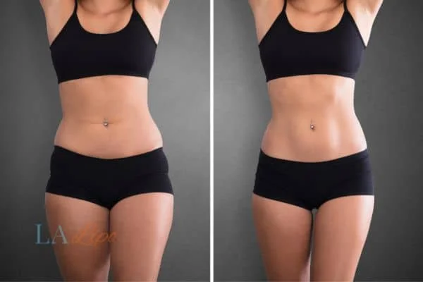 before and after results of non-surgical treatment to help a woman's body image and mental health Rutland