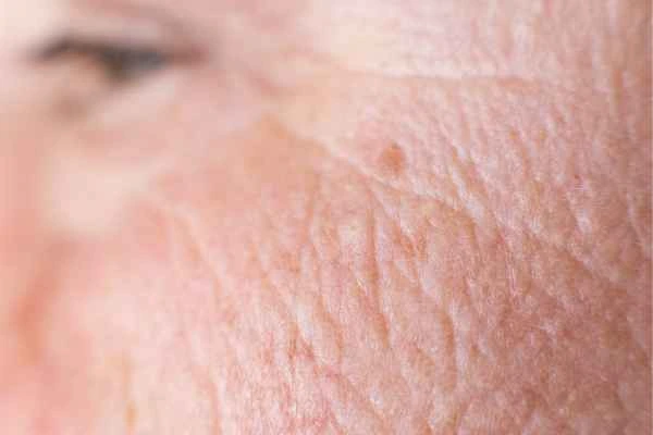 close up picture of a woman's face showing an age spot Rutland