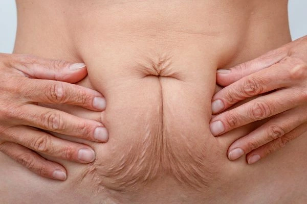 Image of a woman's stomach with loose skin - example of skin tightening Rutland options
