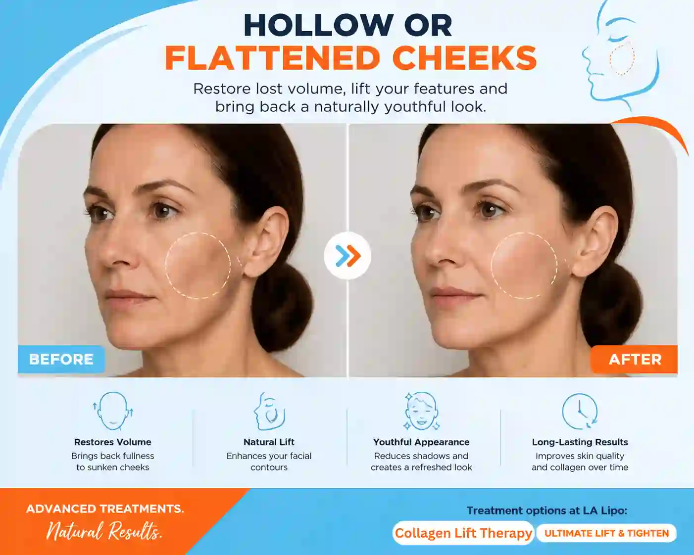 Sign #4: Hollow or Flattened Cheeks Rutland