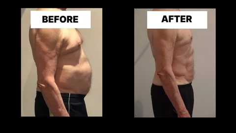 What Symptoms Can Diastasis Recti Cause in Men? Weak Core, Back Pain and Poor Posture Rutland